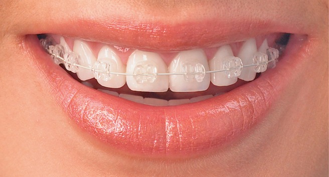 Brackets cerámicos
